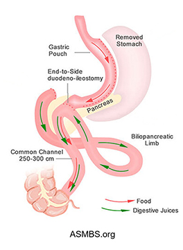 The Single Anastomosis Duodenal-Ileal Bypass with Sleeve Gastrectomy (SADI-S) Procedure