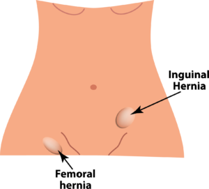 Groin Hernias Diagram