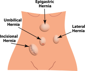 Ventral Hernia Diagram