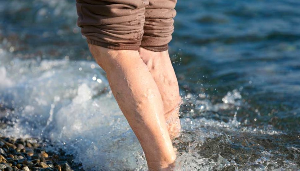 Women with Vericose Veins