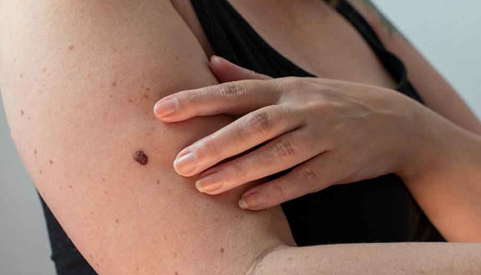 Women with skin lesion on arm