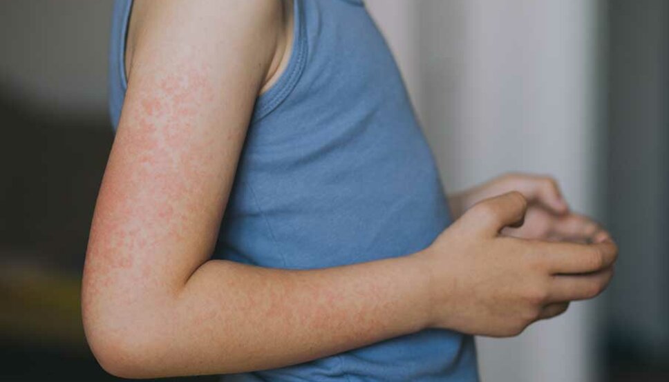 Boy with Measles rash