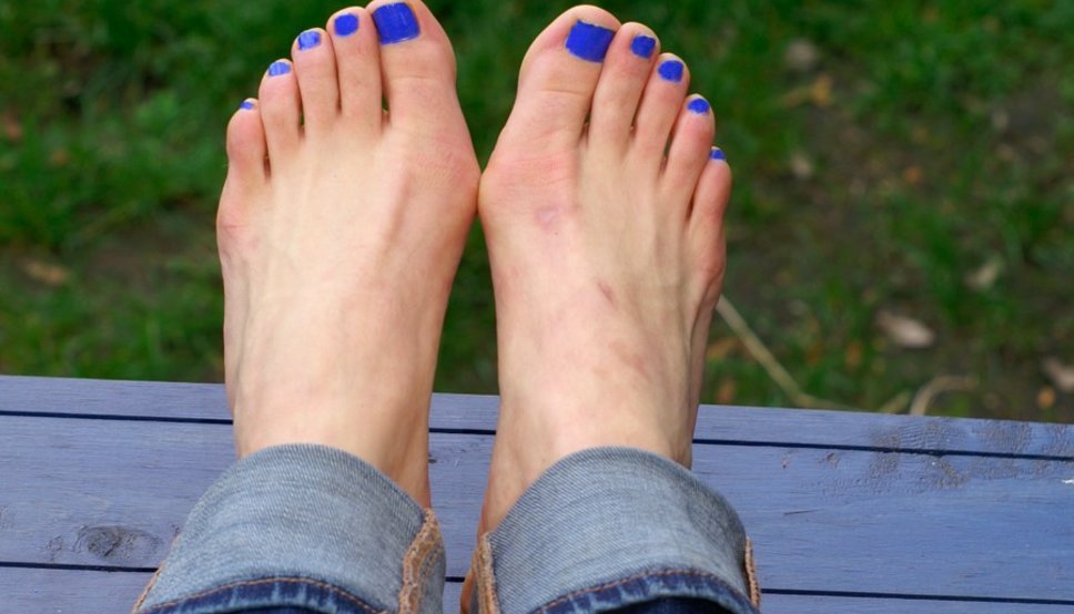 What is a bunion?