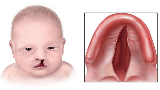 Cleft lip and cleft palate, photo courtesy of the CDC.