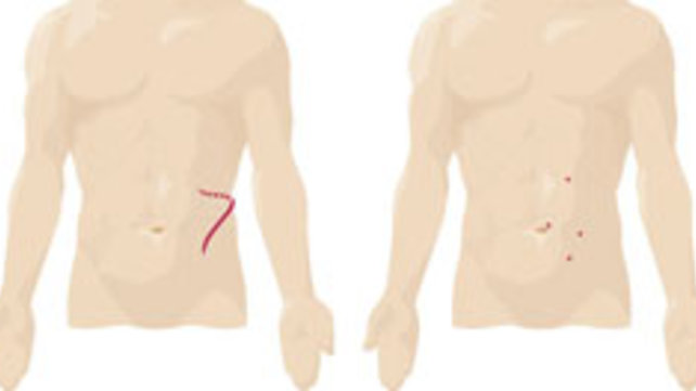 Diagram of kidney surgery methods