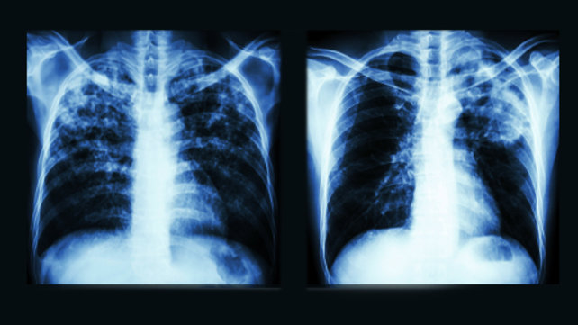 Tuberculosis RISE Clinic