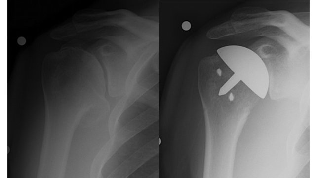 X-rays of pre- and post-operative humeral resurfacing