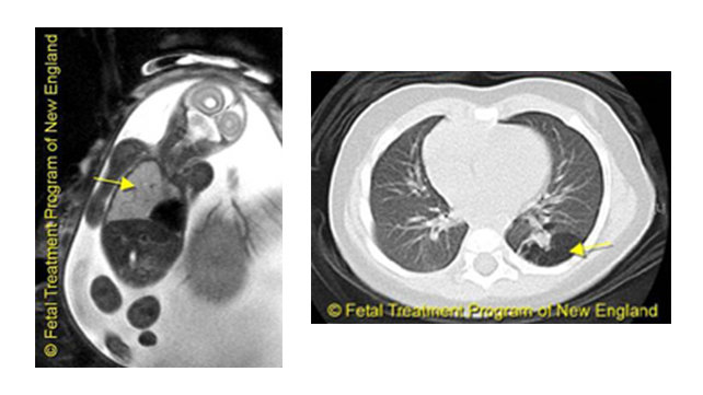 CT scans of fetal congenital lung lesions