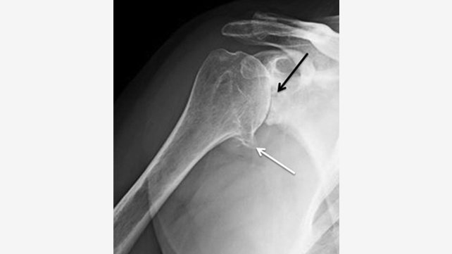 Shoulder x-ray