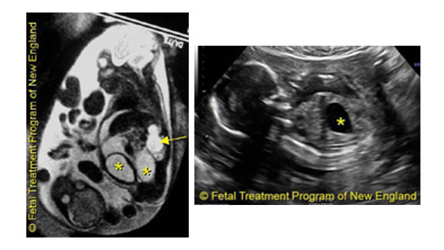 fetal urinary tract obstructions