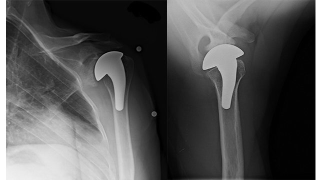 Humeral Arthroplasty with Glenoid Treatment