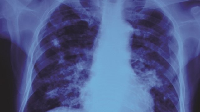 tuberculosis xray