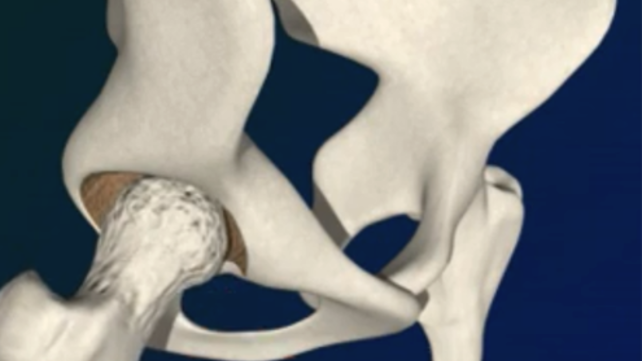 Hip replacement illustration