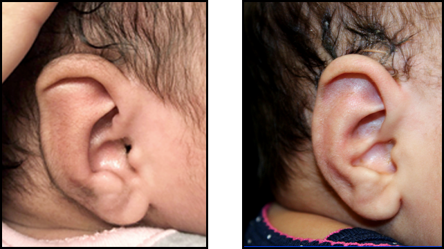 A baby's ear before and after non-surgical molding.