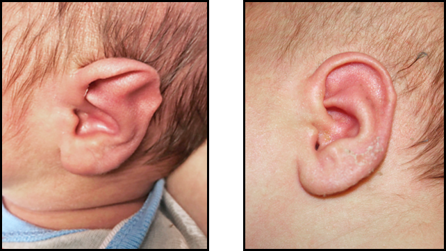 A baby boy's left ear before and after non-surgical molding.