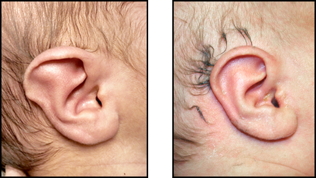 A baby's right ear before and after non-surgical molding.