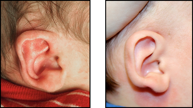 A baby's ear before and after non-surgical molding.