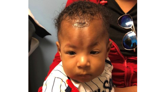 a child's head, 2 weeks after craniosynostosis surgery