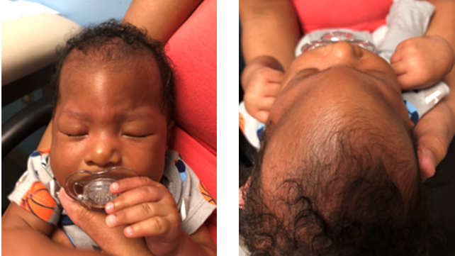 Endoscopic repair for Metopic Synostosis, child's head before suregery.