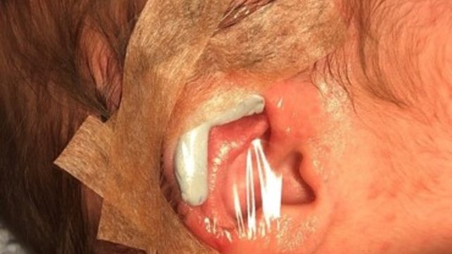 Neo-natal ear deformity