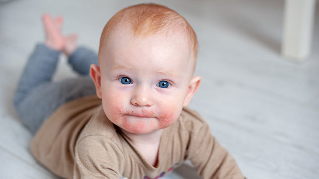A baby with eczema.