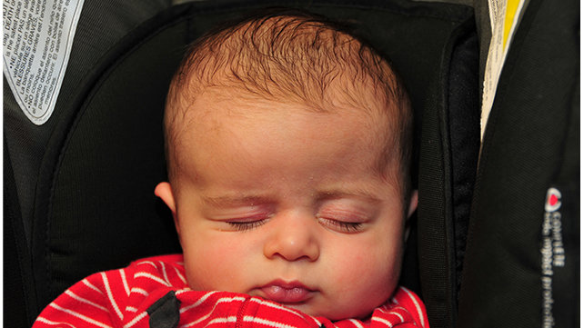 Infant with Coronal Synostosis