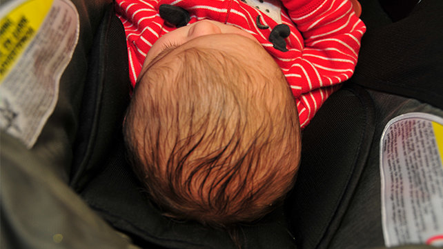 An infant with coronal synostosis