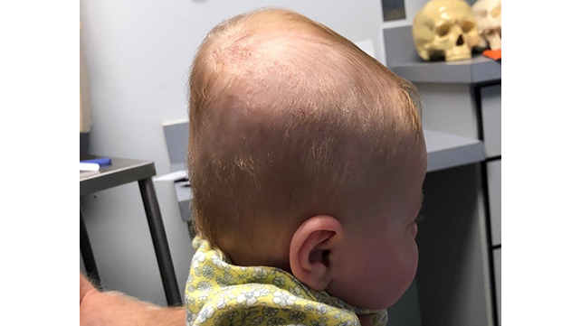 side view of baby with deformational plagiocephaly
