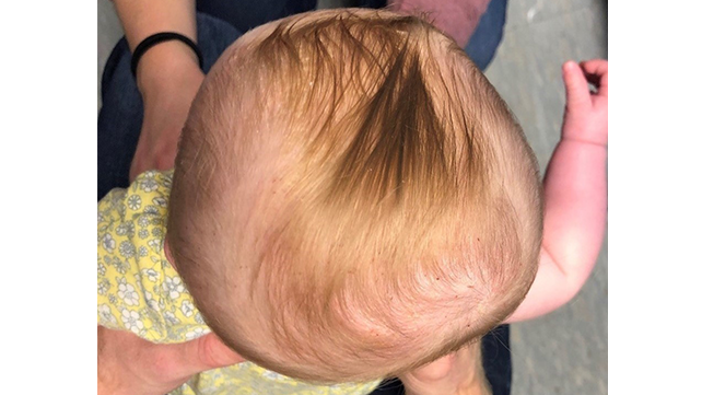 Deformational plagiocephaly, looking at the top of the head.
