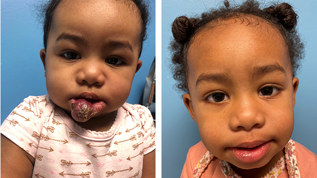 hemangioma repair- before and after