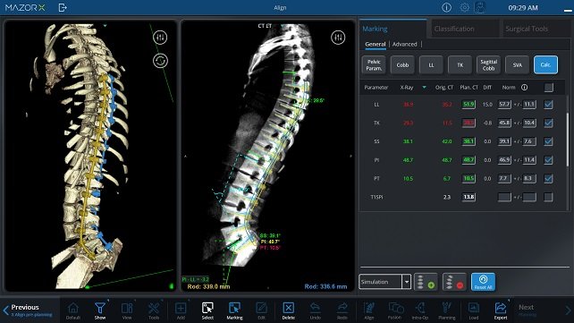 3D spinal visualization generated by Mazor spine robotic guidance system