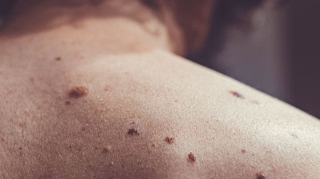 Man with sun damage on back