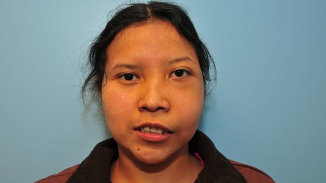 Person with Fibrous Dysplasia