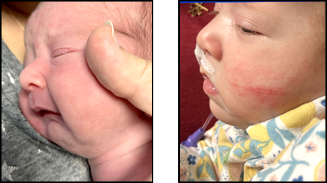 Baby with Pierre Robin Sequence