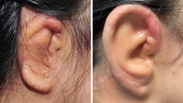 Before and after photo for patient with microtia.