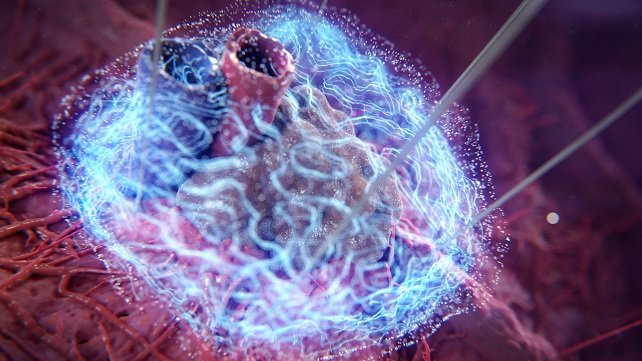 Tumor ablation in progress