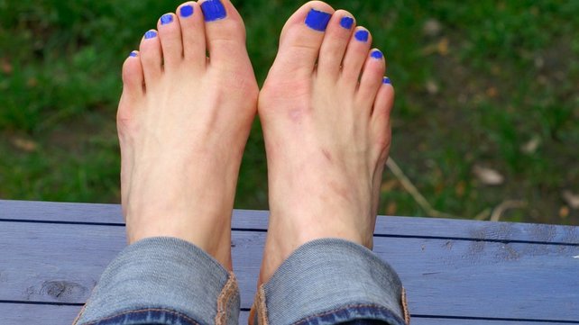What is a bunion?